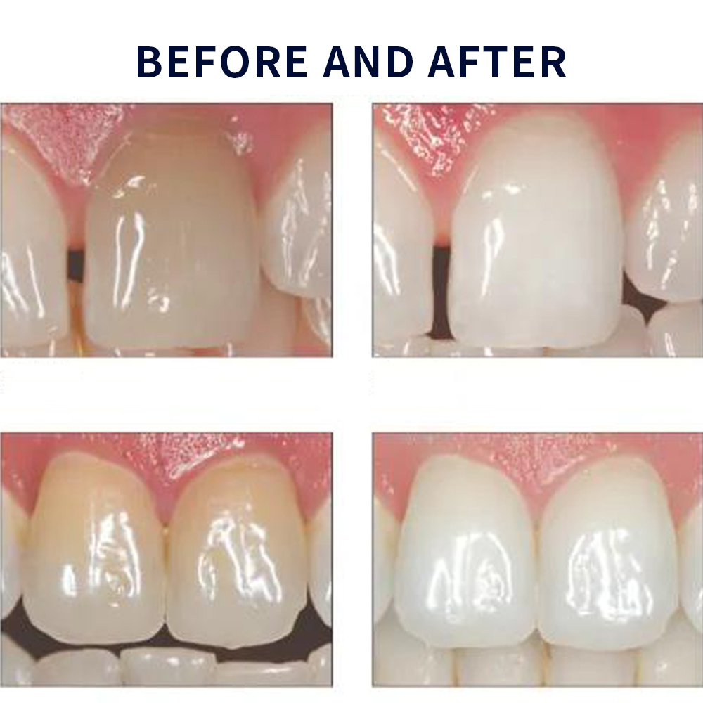 مجموعة جل تبييض أوباليزانس ، م - مراجعة Teeth Whitening With Hydrogen Peroxide وسعره