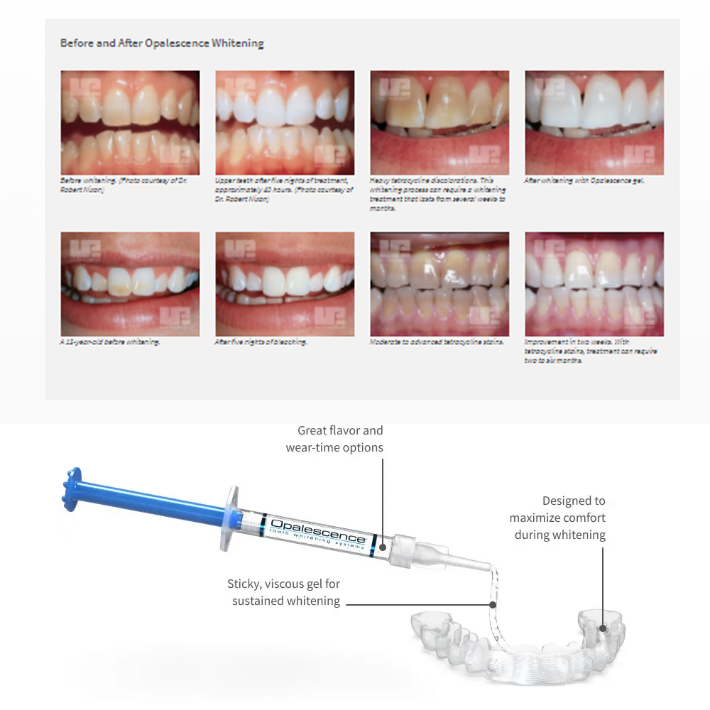 مجموعة جل تبييض أوباليزانس ، م - مراجعة Teeth Whitening With Hydrogen Peroxide وسعره