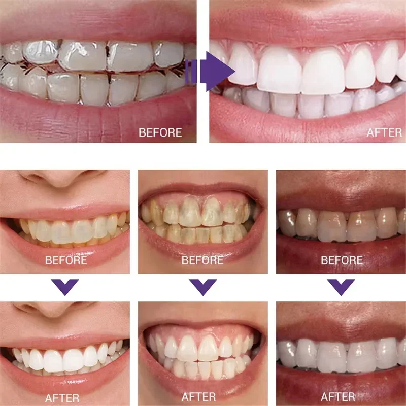 معجون أسنان مبيض لتنظيف الأسنا - مراجعة Teeth Whitening Korea وسعره