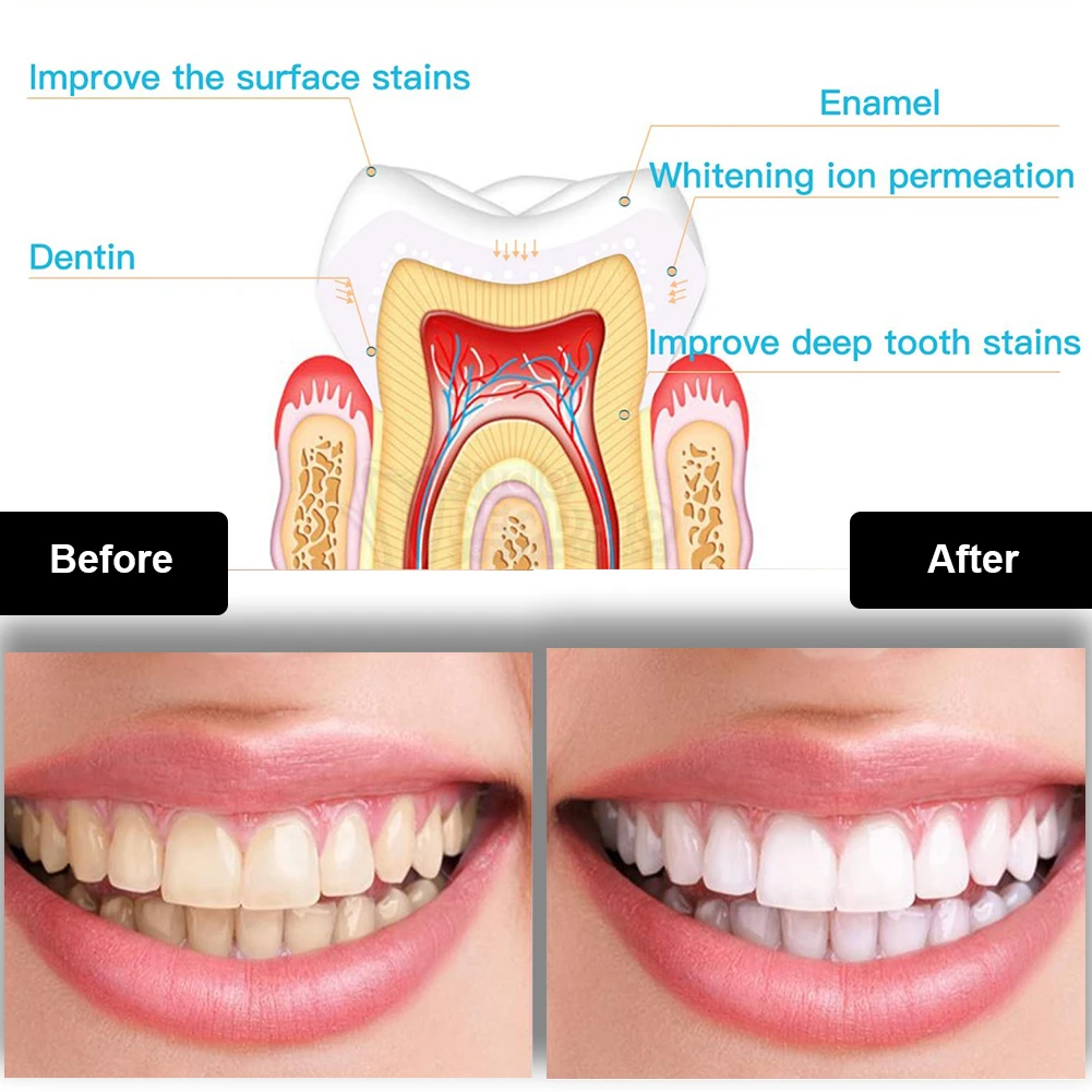 طقم تبييض الأسنان صغير 16 LED  - مراجعة Teeth Whitening Pen وسعره