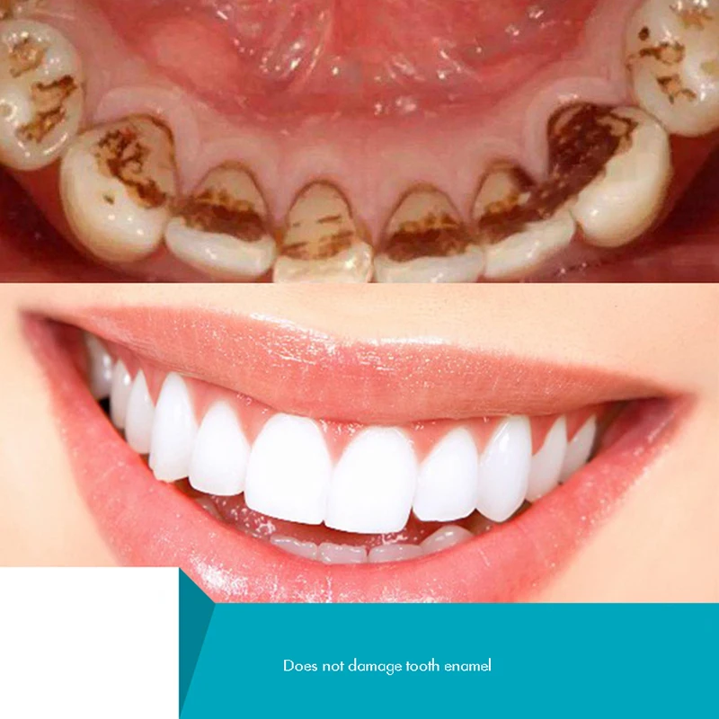 مسحوق الأسنان العشبية ، مسحوق  - مراجعة Teeth Whitening Xylitol وسعره